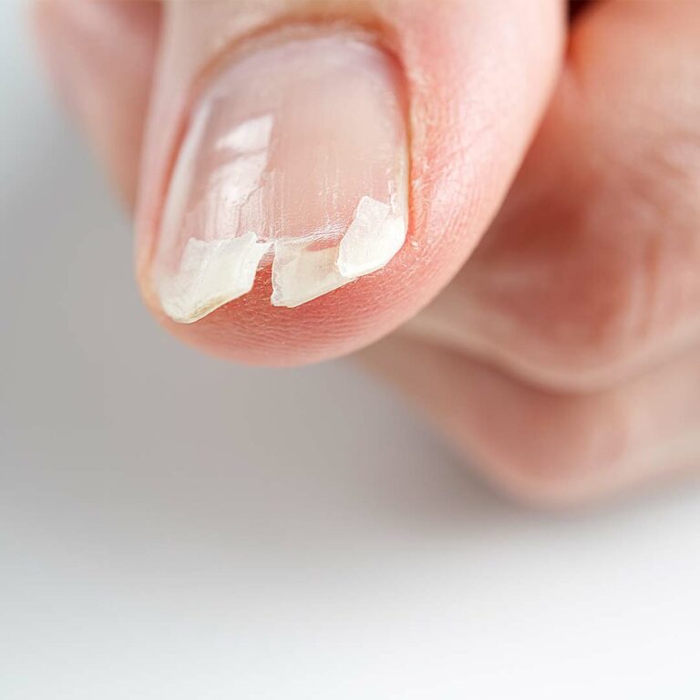 bruechige fingernaegel manifix