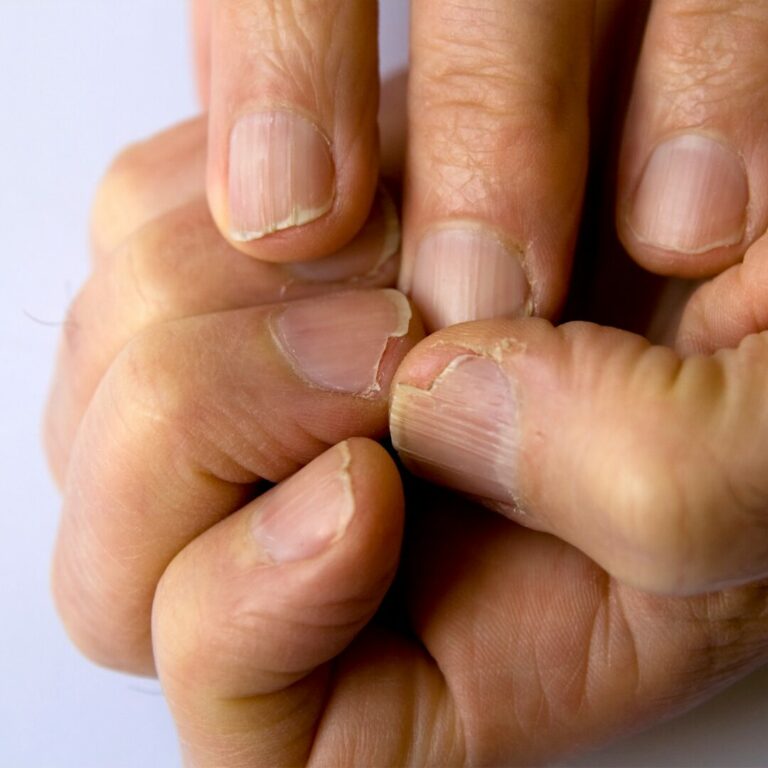 manifix hilft gegen Rillen auf Fingernagel 01