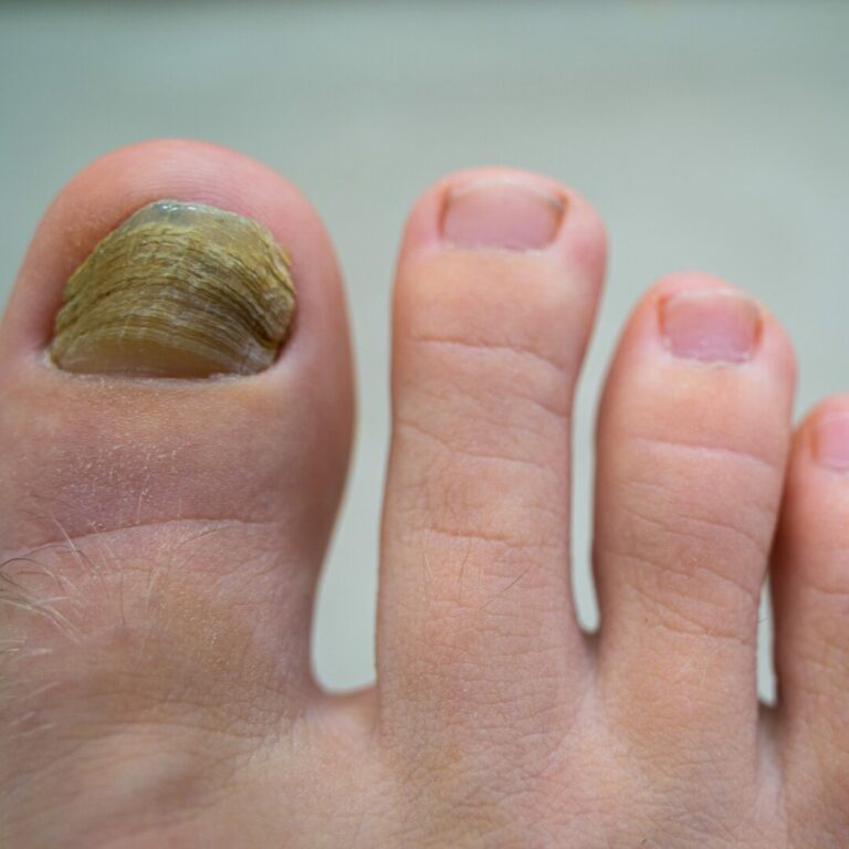 nagelpilz erkennen und behandeln 02