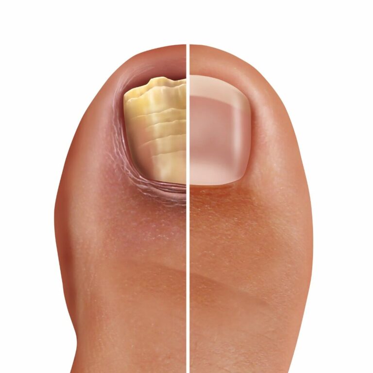 nagelpilz erkennen und behandeln 03