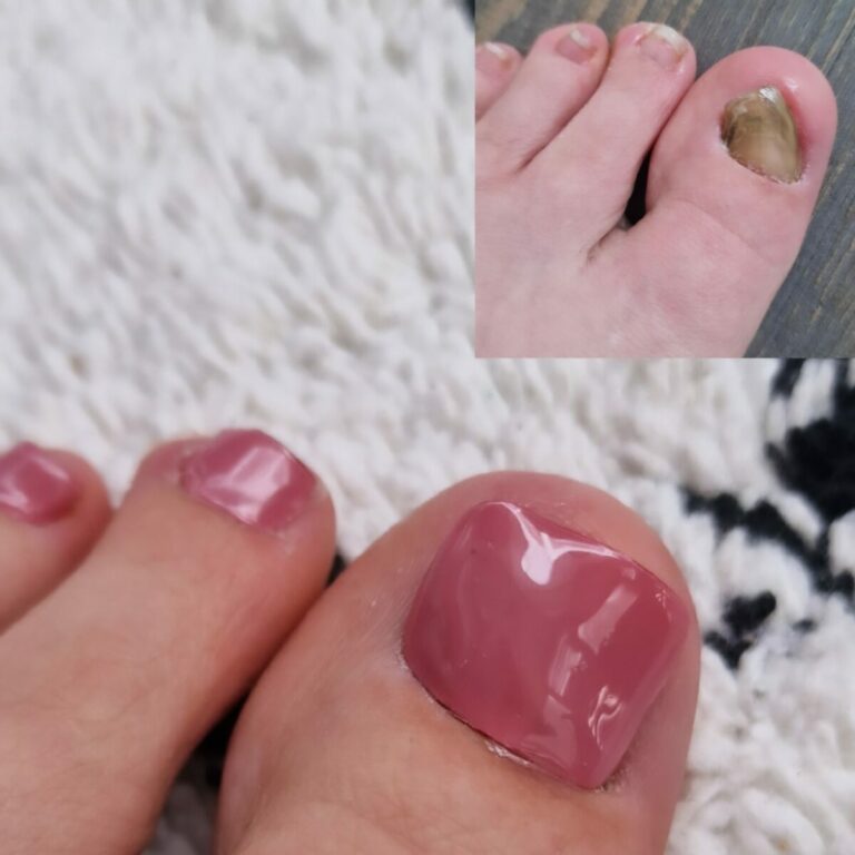 nagelpilz erkennen und behandeln 04