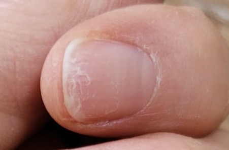 Kaputte Naegel nach UV Folien