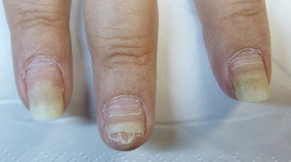 bruechige naegel nach der chemotherapie