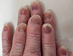 bruechige naegel nach der chemotherapie2.jpg